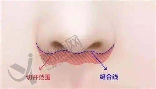谭拯人中缩短:内缝技术减疤秘籍