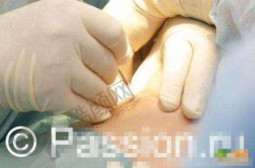 段国新隆胸实例