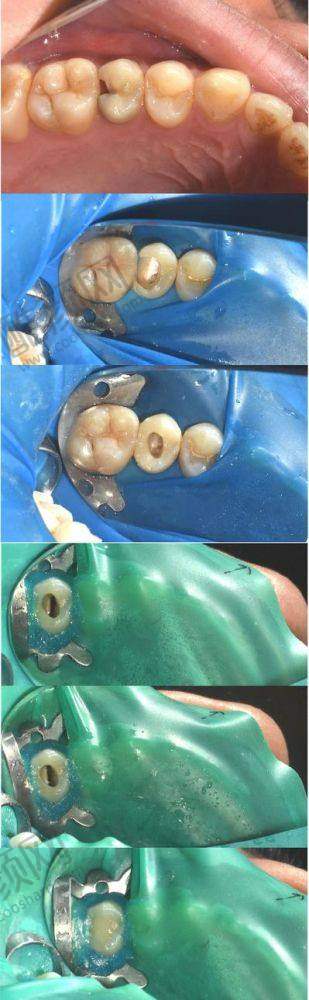 上海鼎植口腔根管治疗技术亮点