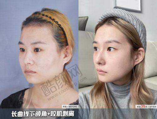 北京八大处张超:下颌角手术的精细大师