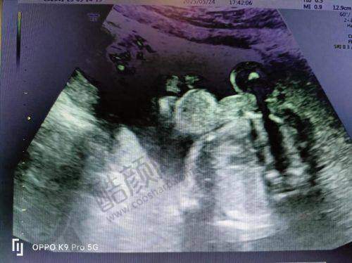 八大处宋涛:唇腭裂修复水平怎么样可靠吗?