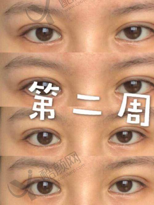 八大处整形医生宋彬双眼皮水平怎么样可靠吗?