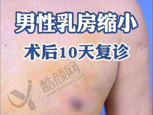 揭秘雌化胸与脂肪胸:外观差异明显
