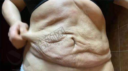 罗飓元隆鼻水平怎么样可靠吗？