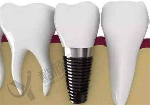 韩相国种植牙实例