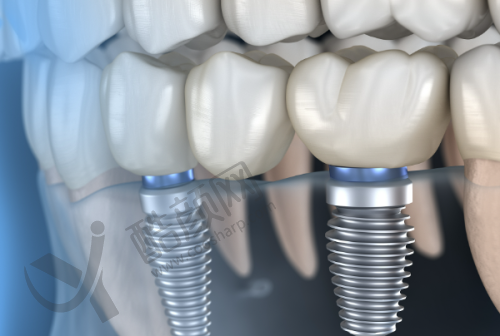 韩相国种植牙水平怎么样可靠吗？