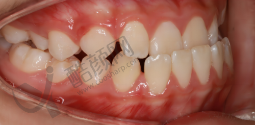 肖步挺种植牙实例