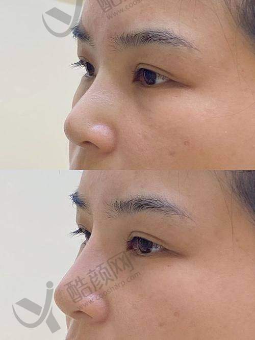 四川米兰柏羽隆鼻价格合理