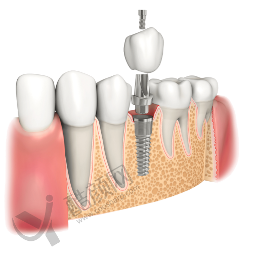 肖林喜种植牙水平怎么样可靠吗?