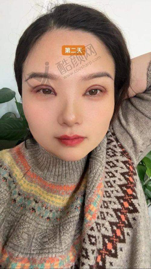 陈小剑医生双眼皮预约方式