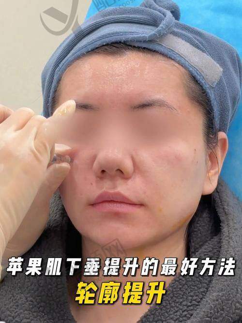 郑州卢建伟苹果肌复位价格:合理透明,丰俭由人