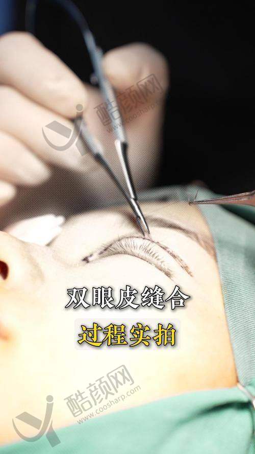 浦雯雯医生的成功实例