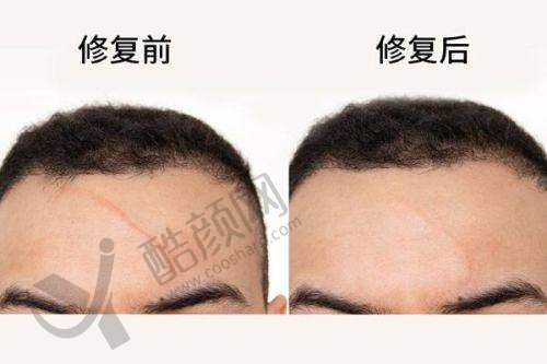 广州曙光医学整形美容医院祛疤之多手段修复成效显著