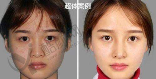 深圳刘冰鼻整形实例