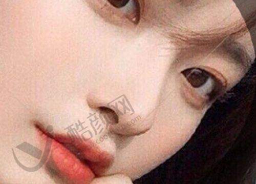 深圳艺星文丰膨体隆鼻水平怎么样可靠吗？