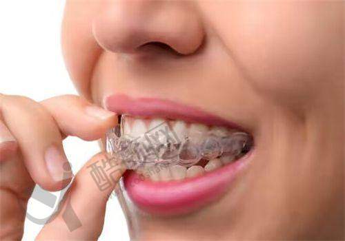 成人深覆颌矫正:提升面部美观水到渠成