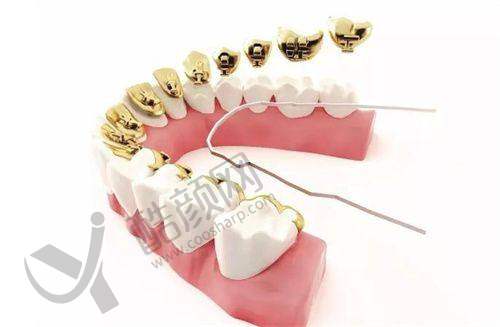 成人深覆颌矫正:改善前牙磨耗刻不容缓