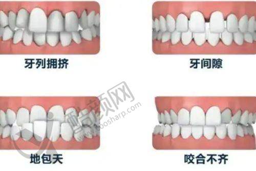 成人深覆颌矫正:改善心理健康顺理成章