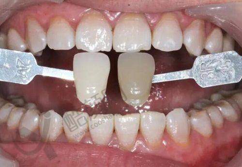 七、江西抚州医学院附属口腔医院价格表：（仅供参考）