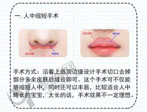 谭拯医生人中缩短手术性价比评估