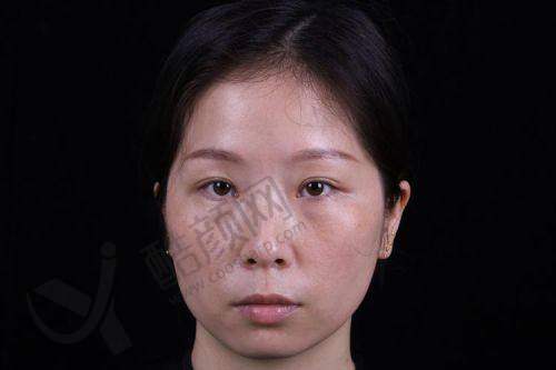 广州曙光医院整眼袋预约及其他信息