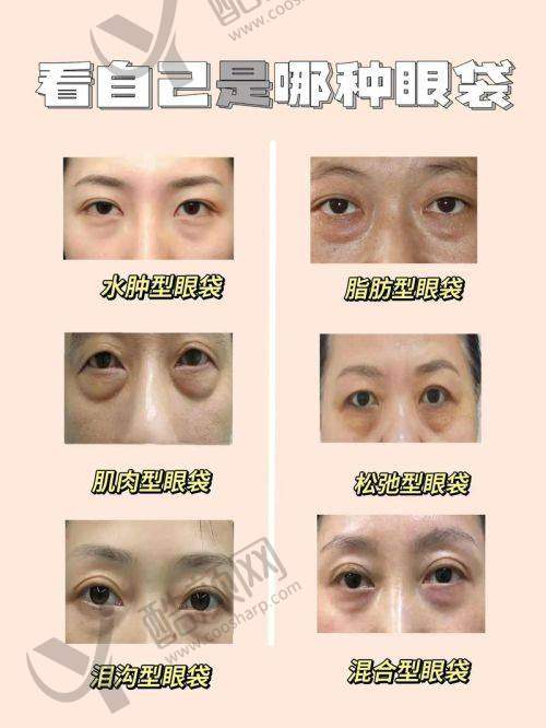 广州曙光医院整眼袋医生技术优势