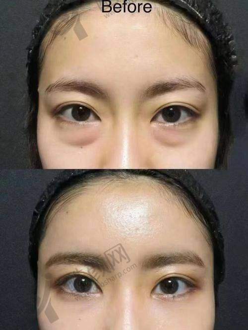 广州曙光医院整眼袋的口碑评价