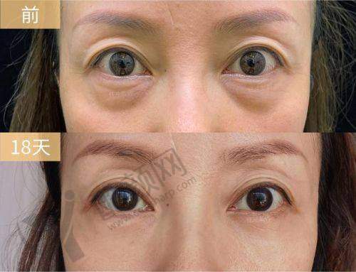 广州曙光医院整眼袋价格表大揭秘