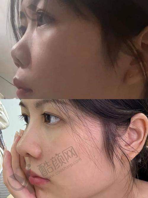 深圳美莱整形梁晓健肋软骨隆鼻水平怎么样可靠吗？