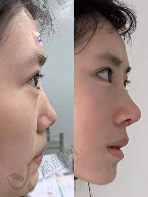 深圳美莱整形梁晓健肋软骨隆鼻实例