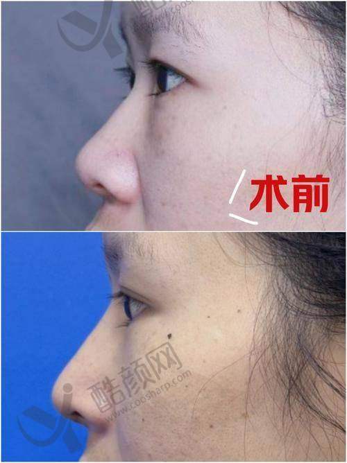 深圳艺星文丰膨体隆鼻实例