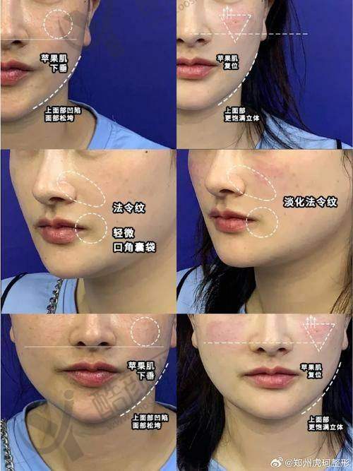 卢建伟苹果肌复位修复时间影响因素