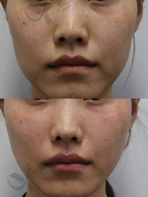 卢建伟苹果肌复位技术特点