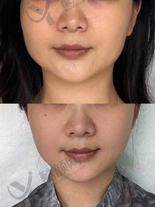 卢建伟苹果肌复位成功实例