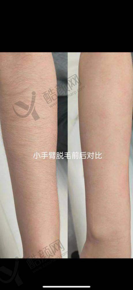 南方医 科 大学南方医院——专精脱毛技术保护