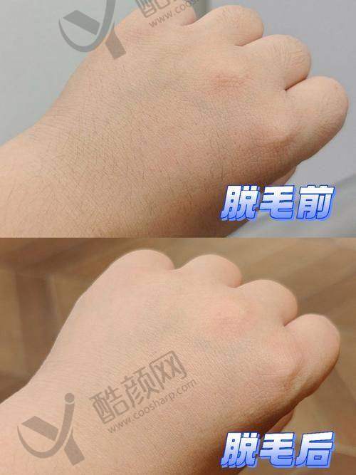 广东省人民医院——具有影响力医院的脱毛优势