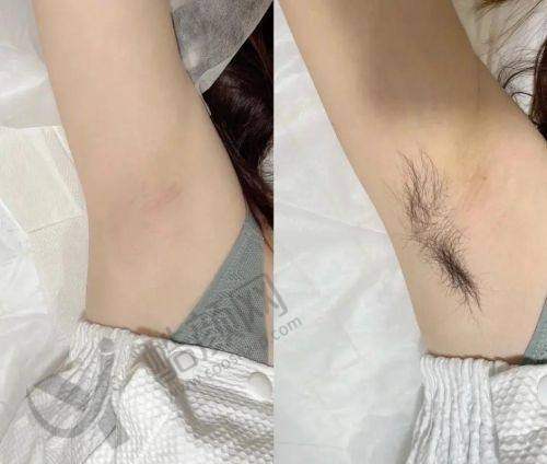 广州医 科 大学附属第一医院——脱毛服务优质体验