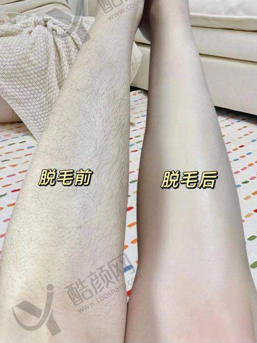 中山大学附属第三医院——综合实力助力脱毛治疗