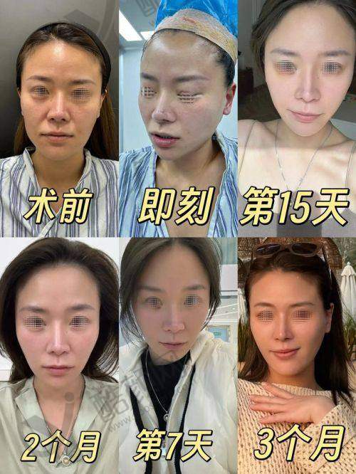 张海明医生拉皮手术技术优势