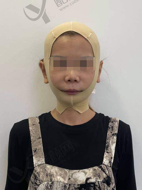 张海明医生双眼皮手术技术优势