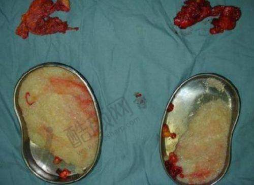 杨庆华医生：内镜技术助力取出