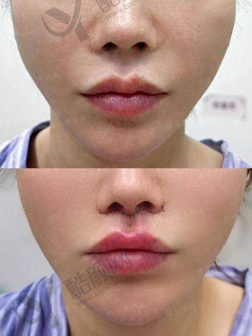 震撼!手术过程,见证自然延长与微立体雕刻奇迹