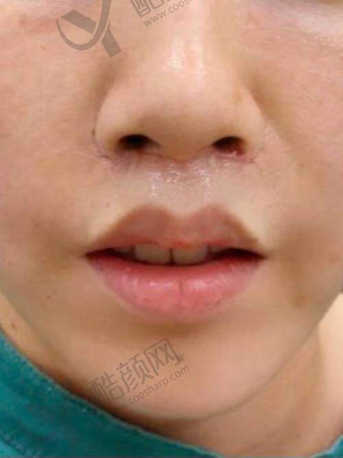 震撼!术后修复,自然延长与微立体雕刻成效渐显