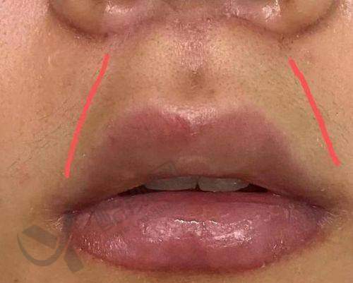 谭拯医生人中缩短手术价格影响因素