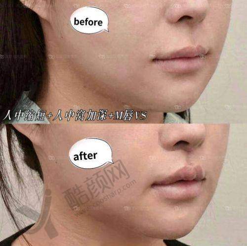 深圳做人中缩短术医生之陈敬武