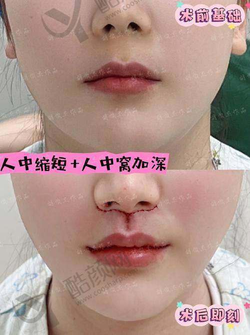 深圳做人中缩短术医生之廖祥俊