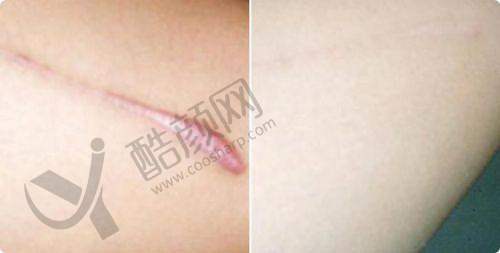 广州曙光医学整形美容医院祛疤之精良技术