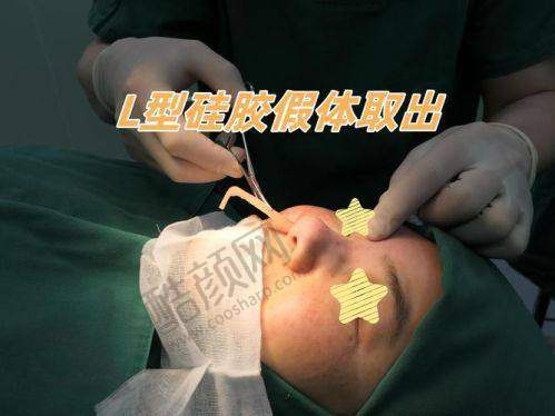 冯雁平隆鼻假体价格表