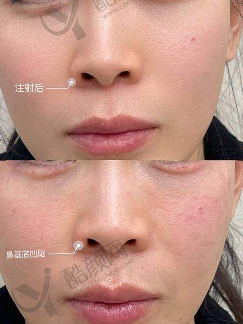 鼻基底填充选啥材料好？自体软骨填充优势揭秘