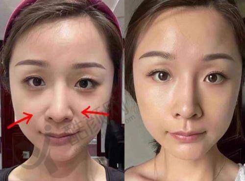 鼻基底填充选啥材料好？膨体/硅胶假体填充优势揭秘